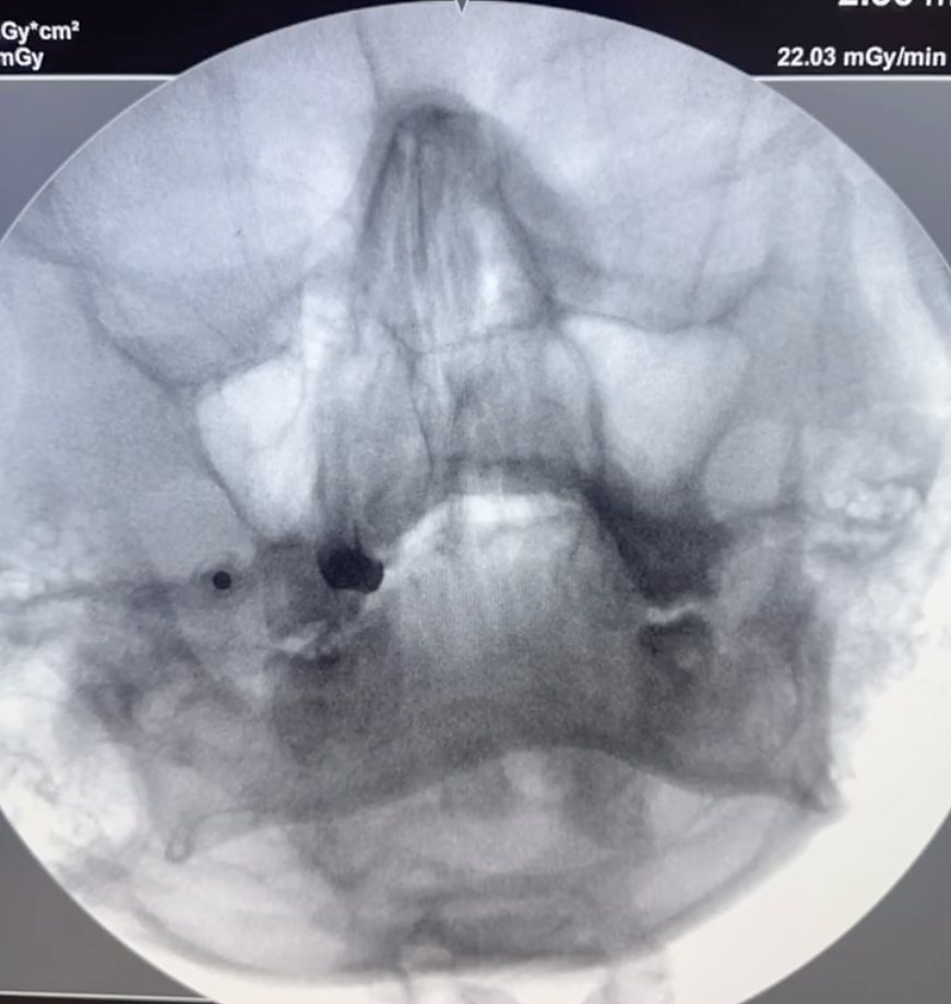 Imagem de radioscopia durante bloqueio do nervo trigêmeo